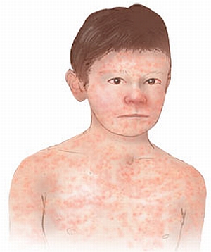 Childrens health - Measles
