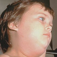 Childrens health - Mumps