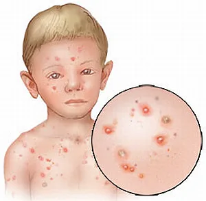 Childrens health - Chicken pox