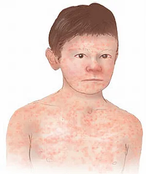 Childrens health - Measles